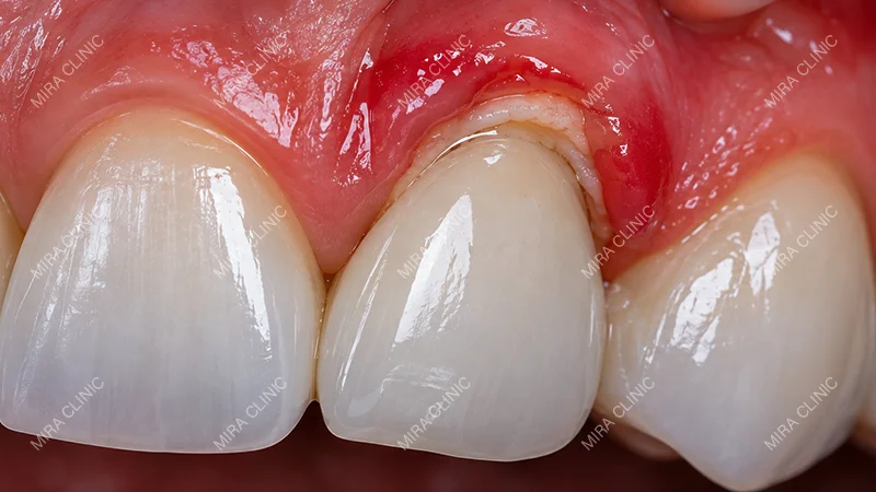 Gum irritation